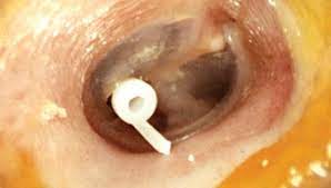 Myringotomy (मायरिंगोटॉमी) Ear Surgery in Hardoi